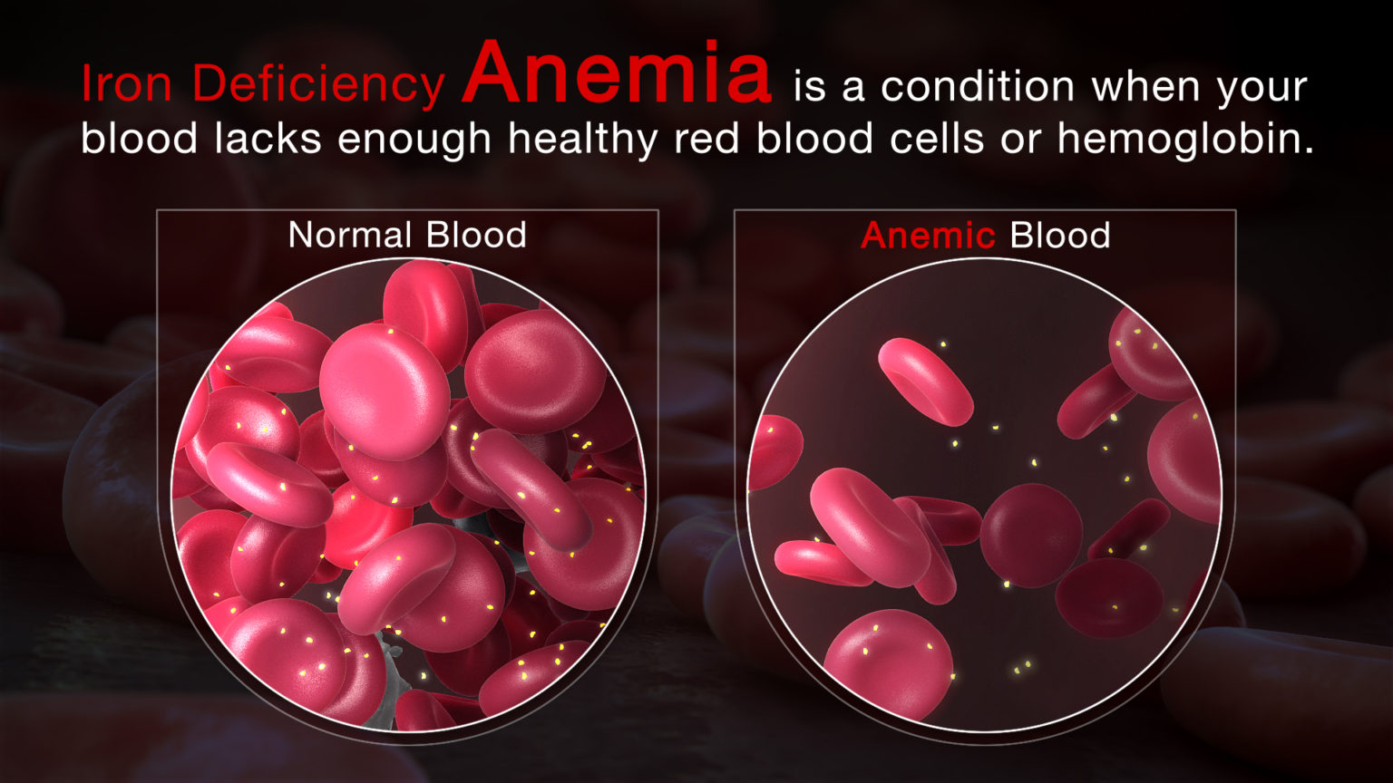 Who Is At Higher Risk Of Iron-deficiency Anemia? - Nutricomplete